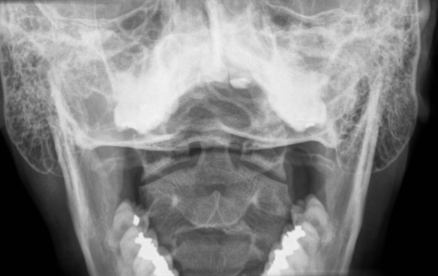 Understanding Disc Herniation: Symptoms, Diagnosis & Treatment Options