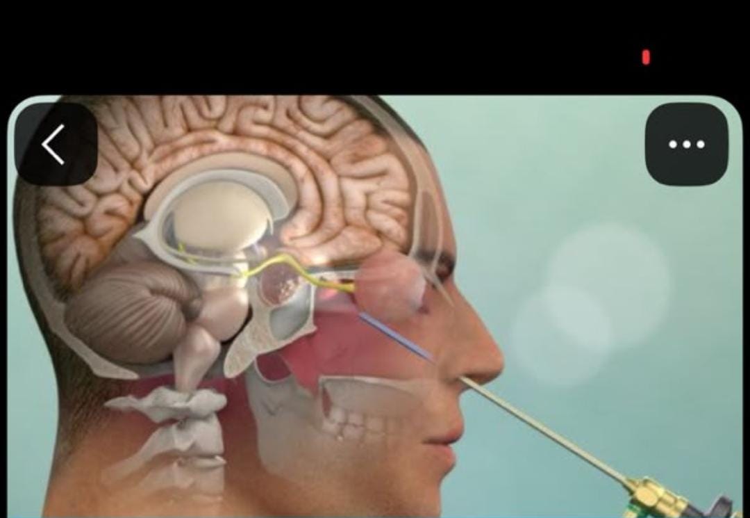 Skull base endoscopy