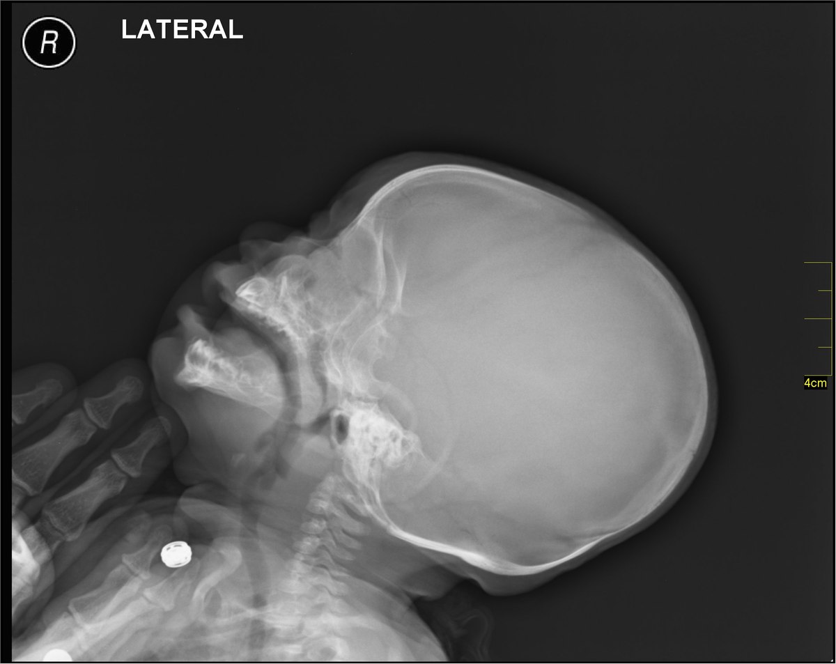 Spinal Fusion