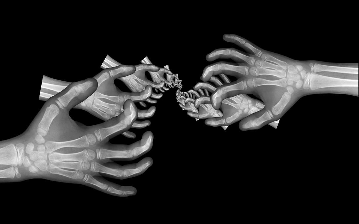 Carpal Tunnel Release