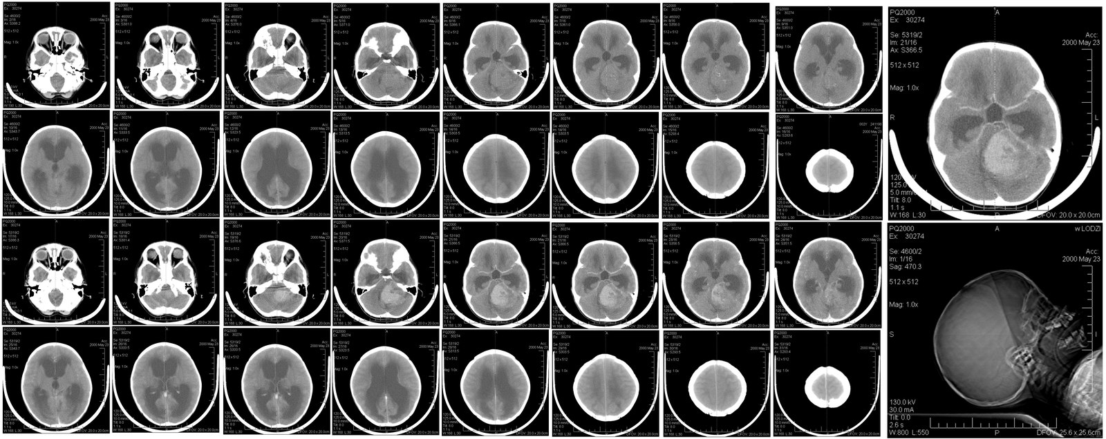 Living with Hydrocephalus
